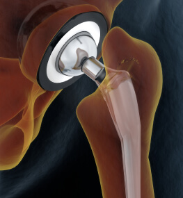 Ендопротезування